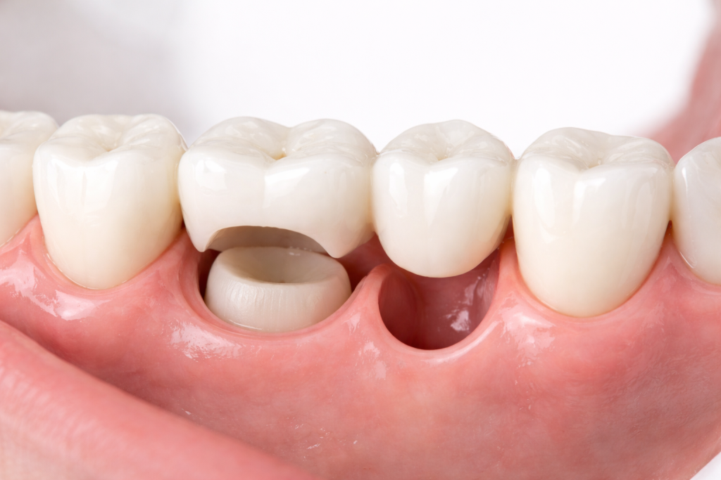 DENTAL CROWNS & BRIDGES