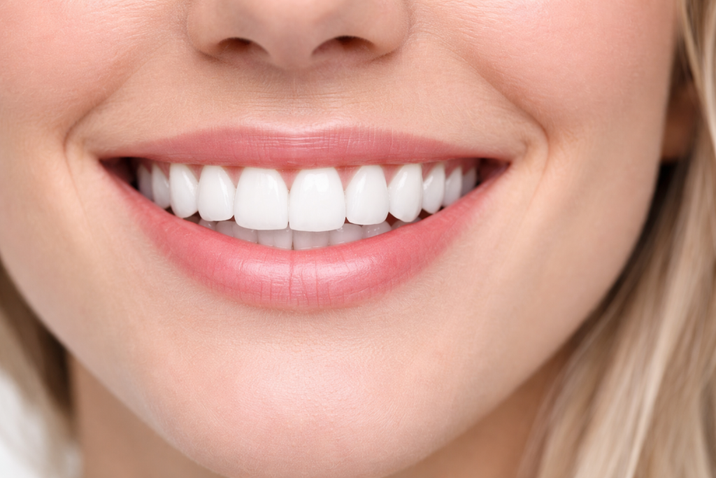 VENEERS