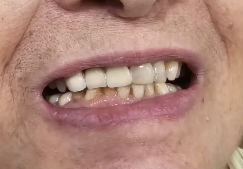 Anterior PFM (Porcelain-Fused-to-Metal) Bridge