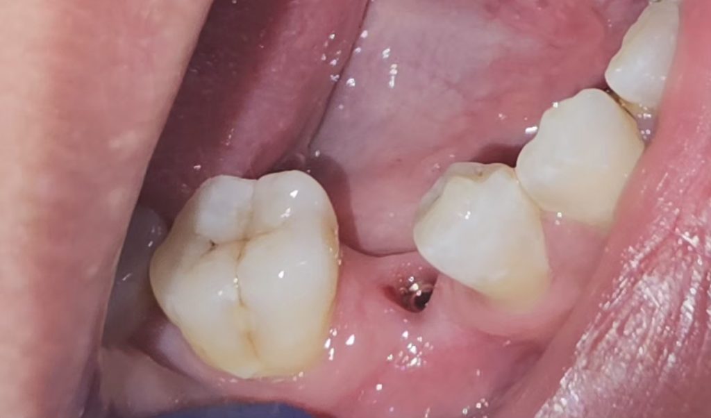 Premolar Implant