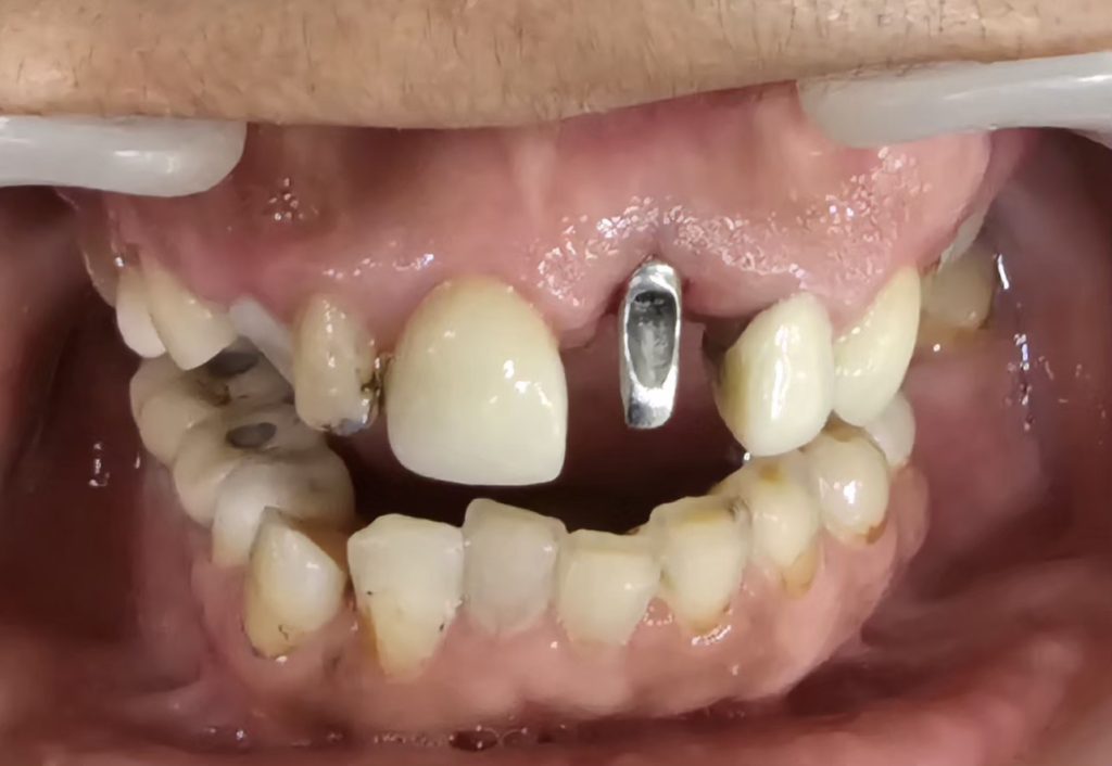 Anterior Implant: