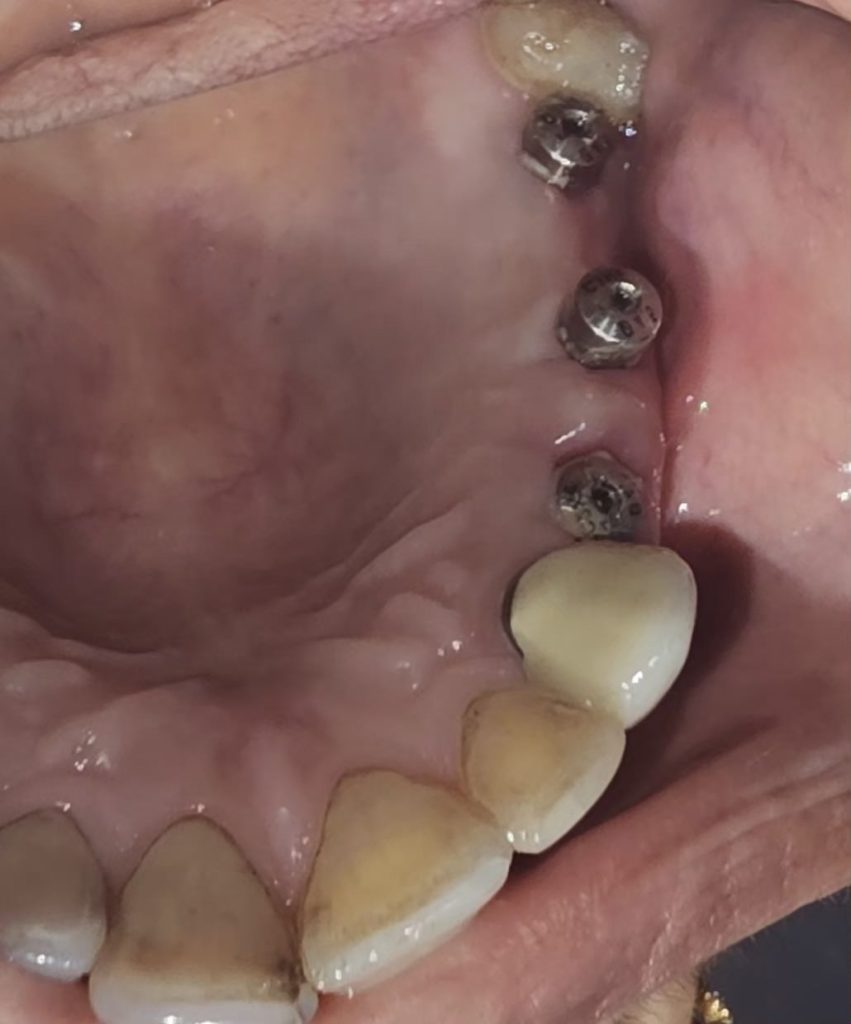 Dental implant bridge